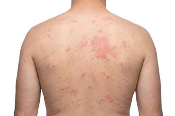Back Skin Rash or ringworm on Adult Male isolated on White or transparent background cutout 