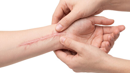 Close-Up of Healed Scar on Human Wrist isolated on White or transparent background
