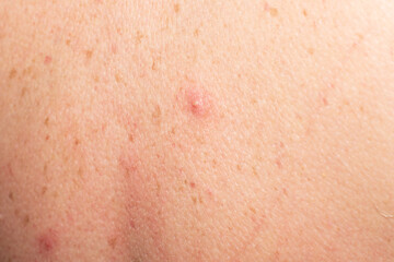 Fototapeta premium Close up red skin pimple inflammation detail