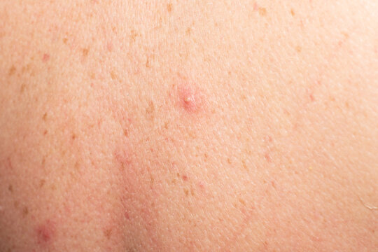 Close up red skin pimple inflammation detail
