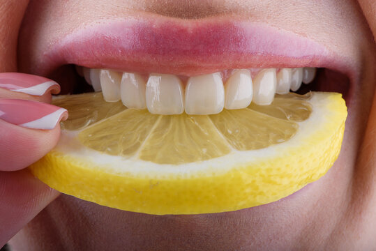 Close up of female teeth biting lemon slice showing ceramic veneers and natural dental care concept