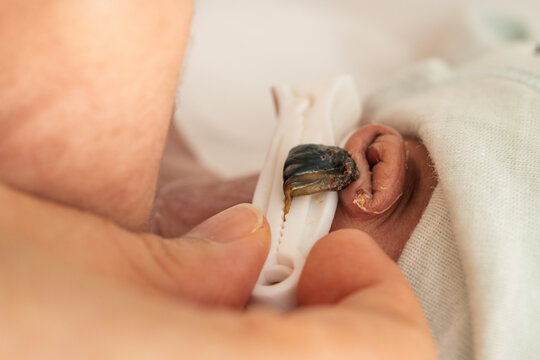 Close-up of a newborn&rsquo;s umbilical cord stump secured with a plastic clamp. The drying stump is part of the natural healing process during the first days after birth.