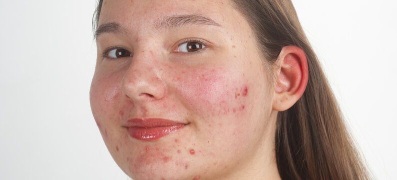 Pimple on face. Skin acne texture. Close up pimple skin. Problem skin with pimple. Pimples, acne, pores, scars on face. Pimple treatment. Pimples on face.
