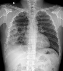 Medical chest X-ray demonstrating right lung abnormality