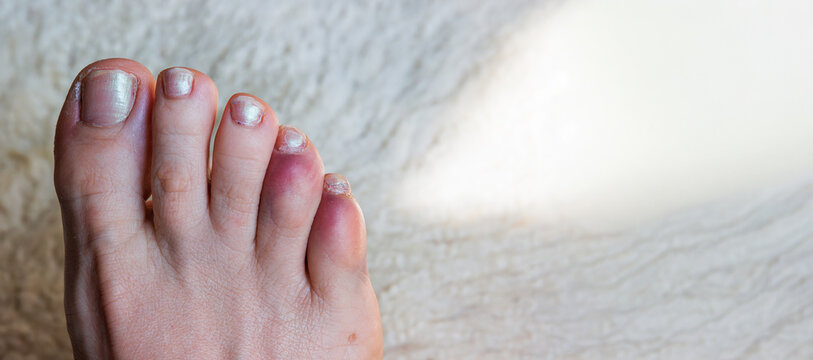 Close up of a bare foot with a broken or sprained bruised reddened toes phalanges. Copy space
