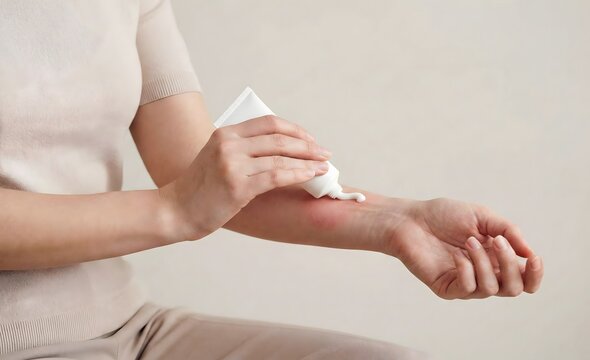 Person applying medical cream from white tube on red skin allergy rash on forearm Generative AI