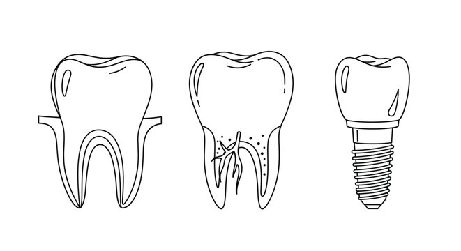 Set of dental diagrams illustrating a healthy molar, a tooth with an infected root canal, and a modern dental implant.