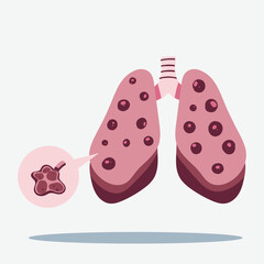 Illustration of human lungs affected by disease, showing multiple nodules and a magnified tumor.