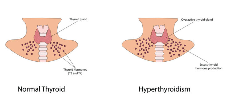 Hyperthyroidism vector illustration