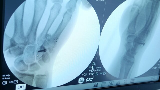Russia Tomsk 05.07.2025: Xray reveals wrist distal radius break, Emergency imaging shows clear fracture of wrist radius bone, Radiographic examination indicates distinct fracture in distal