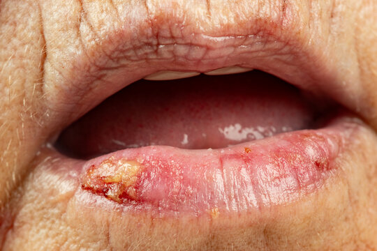 Close up of a lip infection inflammation sore