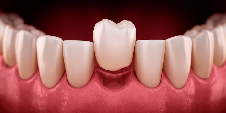 Close up of missing front tooth illustrating dental loss and oral health gap 
