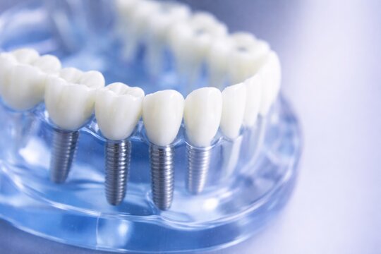 Dental implant model showing replacement teeth and prosthetic screws for oral health and dentistry education