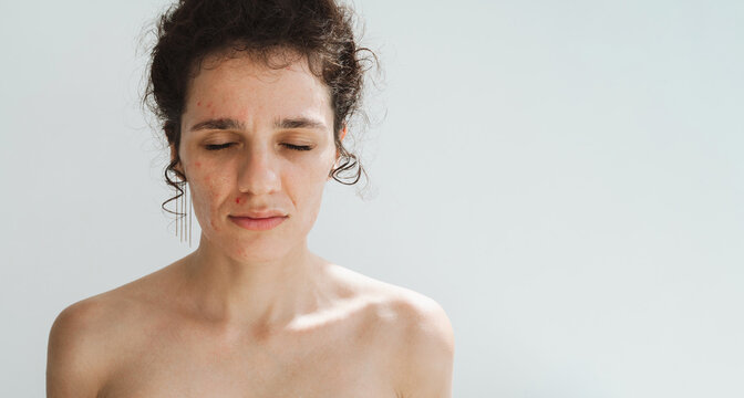 Portrait of young female with pimples and acne on face in close-up on white isolated background. A woman with problematic skin with copy space