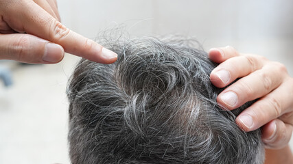 White hair and gray hair of man, hair health problems with hair loss and thinning.