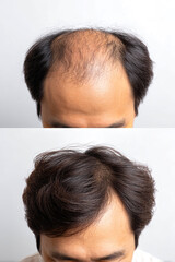 Fototapeta premium The dramatic change in hair from thinning to full and vibrant, highlighting a successful transformation that inspires confidence and style