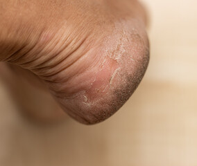 Naklejka premium A person's foot with a callus on the bottom
