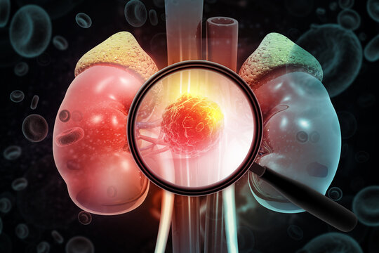 A medical illustration showing a magnifying glass focusing on a malignant renal tumor within a human kidney, representing early oncological diagnosis and advanced nephrology screening. 3d illustration