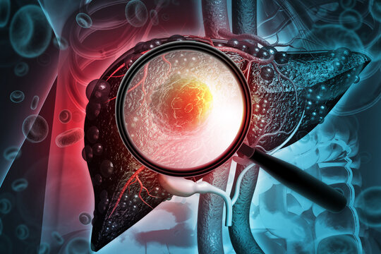 Medical illustration of a magnifying glass detecting a malignant tumor in a human liver for oncological diagnosis. 3d illustration