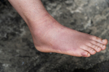 Swollen Foot After Cast Removal of Metatarsal Fracture