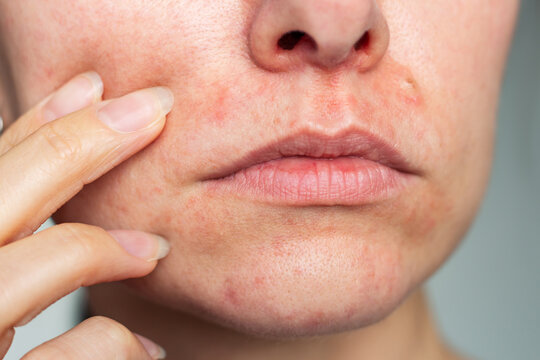 Close-up photo of the face of a young Caucasian woman suffering from perioral dermatitis near the mouth. Skin problems. Dermatology. Skin diseases.