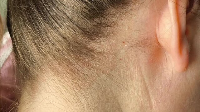 Seborrheic dermatitis on a woman's scalp close-up. Treatment of dandruff on the hair. Dermatological diseases. Trichology