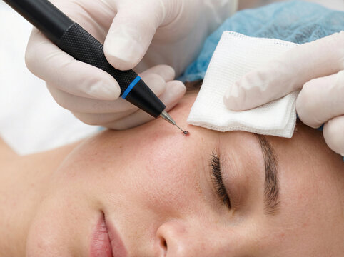 Professional Dermatologist Removing Mole on Woman's Face using Electrocautery Device in Medical Clinic Close Up View