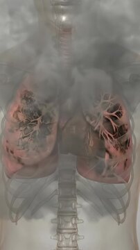 Smoking harms lungs: 3D medical animation shows healthy lungs exposed to cigarette smoke, ending with dark, severely damaged organs. Vertical video
