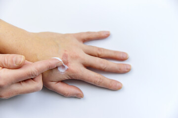 Burn on a woman hand. Selective focus.