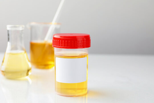 Plastic container and laboratory glassware with urine samples on white table, closeup. Space for text