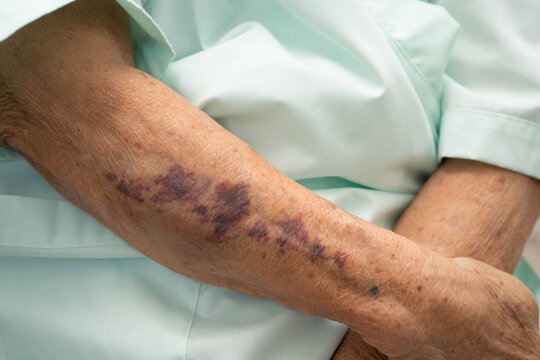 Ecchymosis, elderly bleeding on her arm after taking aspirin.