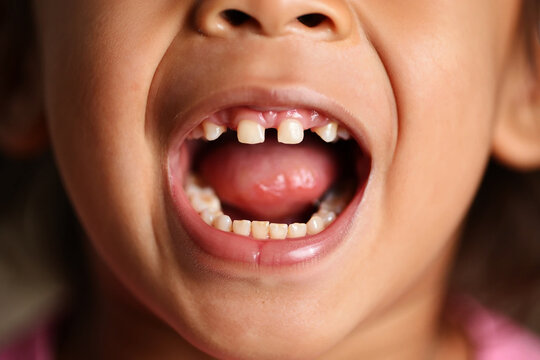 Close up of childs open mouth showing missing front teeth image