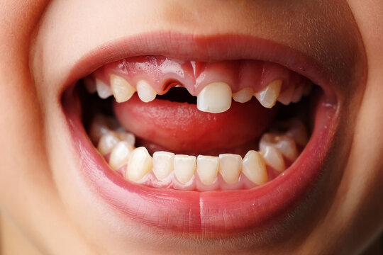 Close up of childs open mouth showing missing front tooth and tongue teeth
