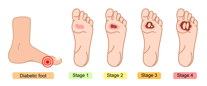 Diabetic foot syndrome stages. Foot wounds, deep ulcers, open wounds. Inflammation, infection, and amputation. Flat Vector illustration for medical, diagnostic, and education.