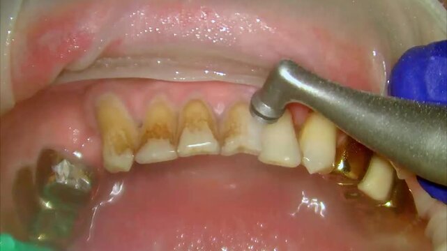 teeth cleaning