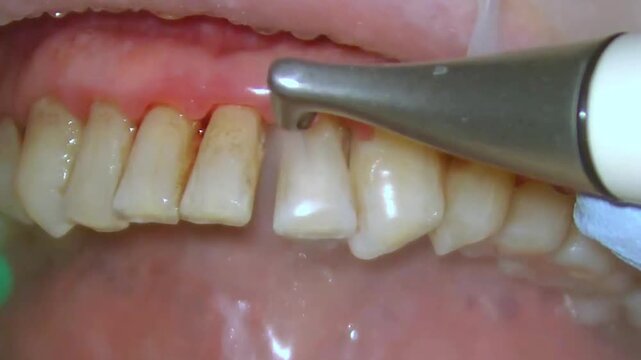 teeth cleaning