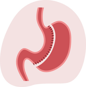 Sleeve Gastrectomy Surgical Intervention Vector Illustration. Laparoscopic stomach reduction procedure showing the gastric staple line
