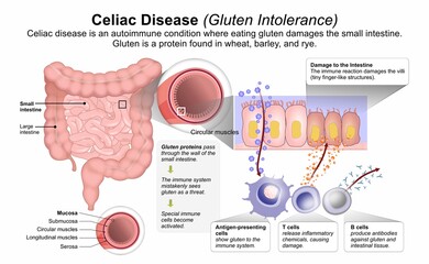 Celiac Disease (Gluten Intolerance) Flashcard