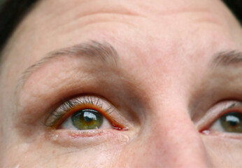 Nahaufnahme Allergie / Weinen: ger&ouml;tetes Auge das nach oben schaut.  Man sieht Tr&auml;nen und das Augenlid ist stark geschwollen
