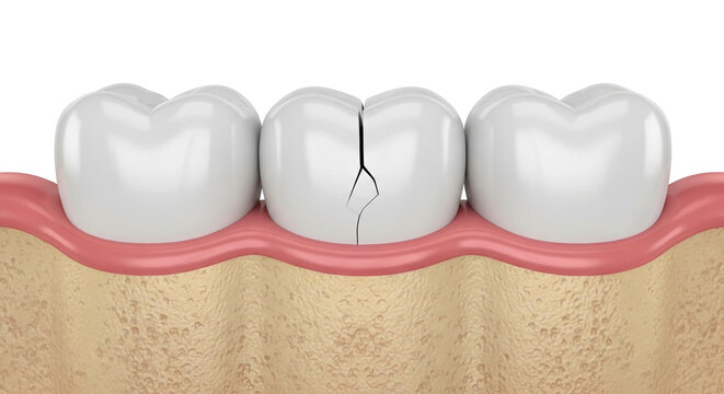 Close up of a cracked human tooth in a dental diagram showing decay and damage illustrating dental health