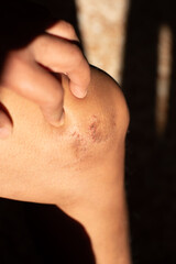 Fototapeta premium Eczema on a person's knee, illuminated with natural light