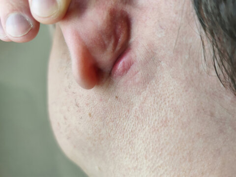 A close-up shot captures a person's ear with a red, swollen area, possibly indicating a skin irritation or infection, as fingers gently touch the lobe.