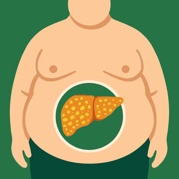 Fat Liver Disease Obesity Flat Vector