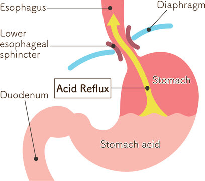 胃酸の逆流のイラスト　Acid reflux illustration
