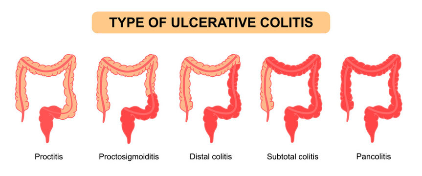 Illustration types of ulcerative colitis. Inflammation of the human digestive system. Inflammatory bowel disease, Inflammation of the human digestive system. Flat Vector illustration for medical