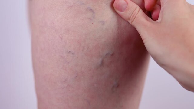 Varicose veins on a woman's leg