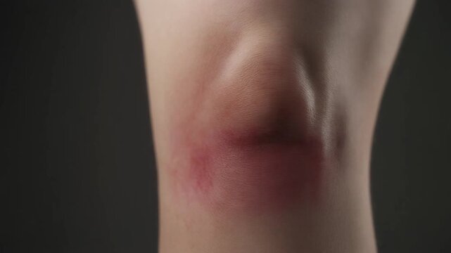 Close-up view of a human knee displaying a visible red patch on the skin, suggesting inflammation, irritation, or a minor superficial injury, highlighting skin sensitivity and health concerns