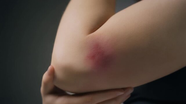 Close-up of a red, irritated skin rash on a person's elbow, indicating an allergy or skin condition