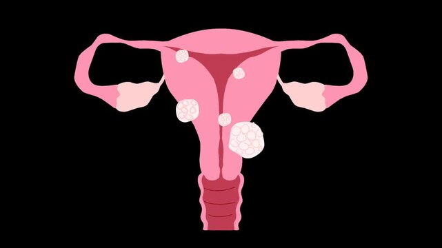 Female reproductive system with uterine fibroids Illustration animation