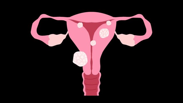 Female reproductive system with uterine fibroids Illustration animation
